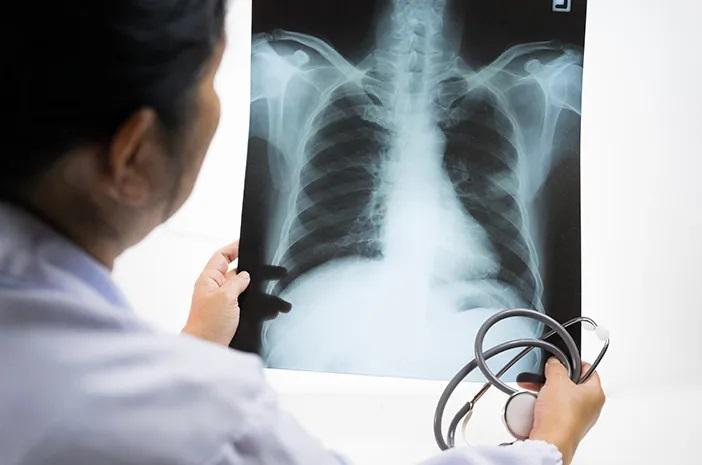 Waspada Indonesia Peringkat 2 Kasus TBC Dunia, Pemerintah Perkuat Kolaborasi Nasional