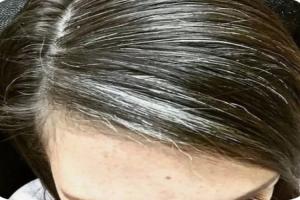 Rambut Memutih dan Beruban, Isyarat Tubuh Alami Gangguan Kesehatan