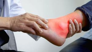 Penjelasan Faktor Pemicu Asam Urat, Ini Hasil Penelitian Modern