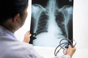 Waspada Indonesia Peringkat 2 Kasus TBC Dunia, Pemerintah Perkuat Kolaborasi Nasional