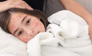 Waspada, Rekapitulasi Dinkes Riau Temuan Suspek Campak Capai 184 Kasus